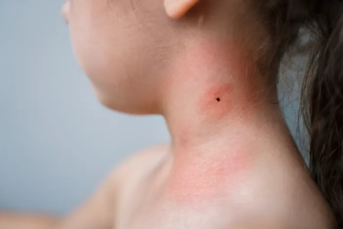 Căpușele: cum prevenim, riscurile, depistarea - Synevo